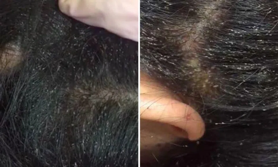 Watch if you dare: Hundreds of head lice crawl on girl's scalp in hair-raising video