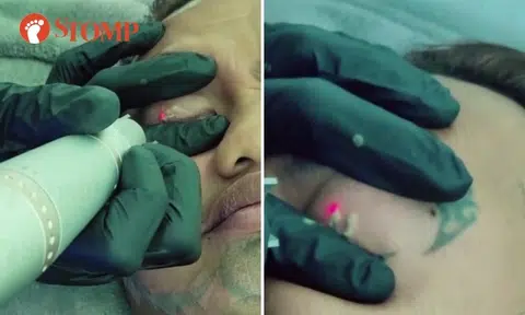 Man shares video showing 'painful' removal of tattoos to discourage youngsters from getting them