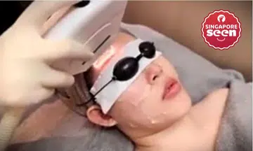 Dynamic pulsed light (DPL) machine facial treatment