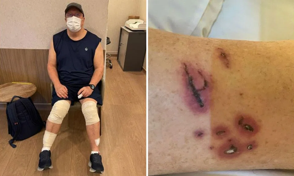 Mr Graham George Spencer was attacked by otters on the morning of Nov 30, 2021, and was left with injuries to his legs, buttocks and finger. PHOTOS: GRAHAM GEORGE SPENCER