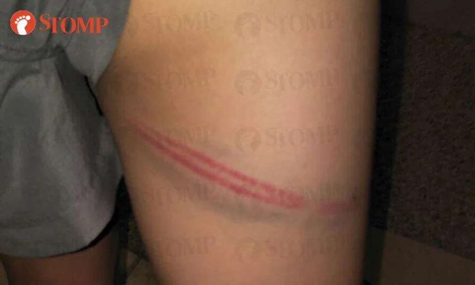 Pri 5 student gets caned: Marks look so severe, says Mum; it's in accordance with rules, says school
