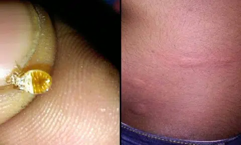 Angry Malaysian passenger complains about serious bedbug infestation on express coach service from KL to JB