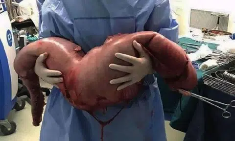 Doctors in China remove 76cm of man's intestines -- along with 12kg of faeces that was inside