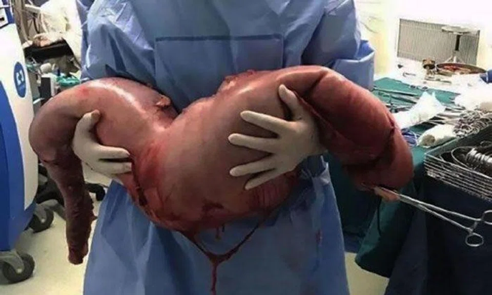 Doctors in China remove 76cm of man's intestines -- along with 12kg of faeces that was inside