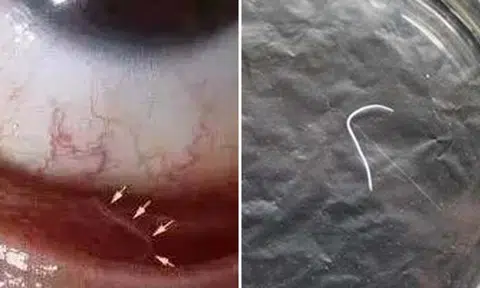 Woman in China skips washing hands after cuddling dog, ends up with 2cm worm in her eye