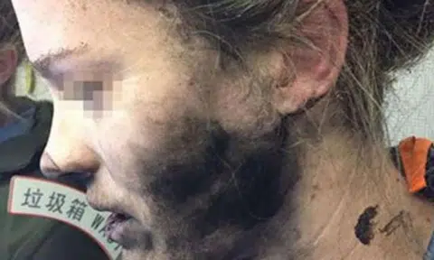 Woman's face and hands burnt after headphone batteries explode on flight to Australia