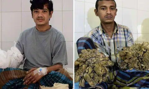 Bangladeshi man Abul Bajandar in a ward at The Dhaka Medical College Hospital in Dhaka, on Jan 4, 2017 (left), and Jan 31, 2016 (right).Photo by AFP