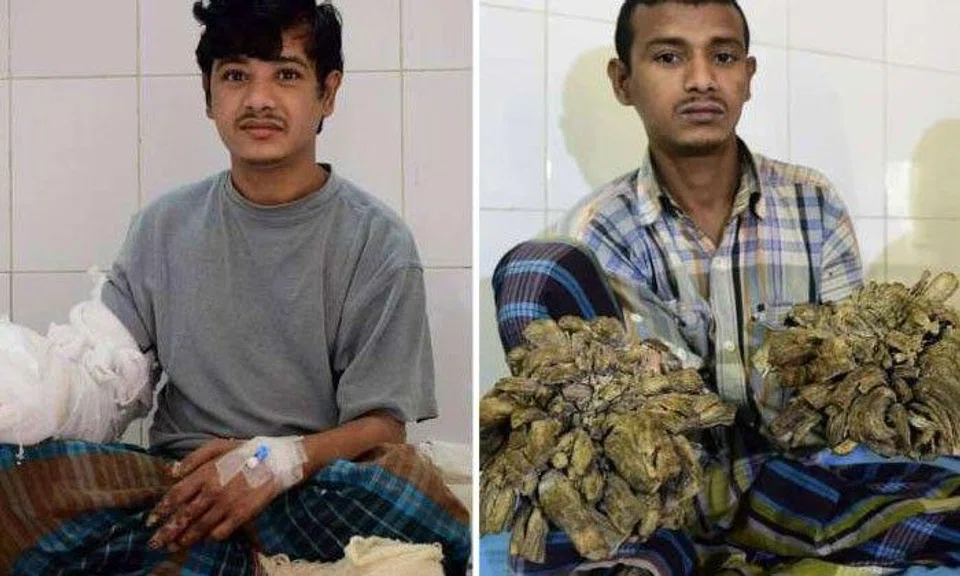 Bangladeshi man Abul Bajandar in a ward at The Dhaka Medical College Hospital in Dhaka, on Jan 4, 2017 (left), and Jan 31, 2016 (right).Photo by AFP