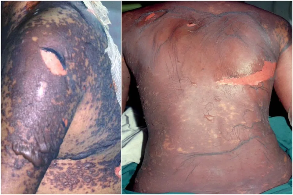 Seven men and two women, aged between 18 and 57, were hospitalised between February 2024 and February 2025.