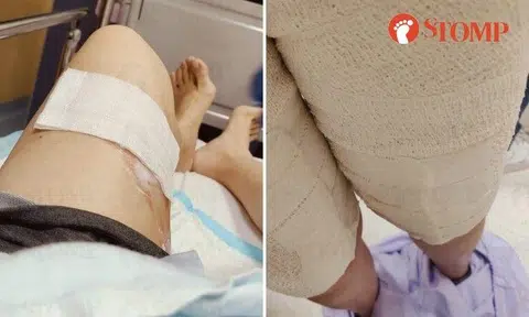 Stomper Jen was diagnosed with second-degree burns.