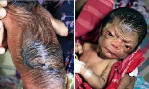 Baby born in Bangladesh looks like an old man because of disorder -- and is expected not to live for very long