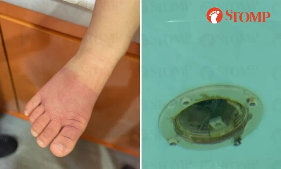During a visit to the BabySpa at HarbourFront Centre, the Stomper's 14-month-old daughter's foot was accidentally sucked into a hole underwater in the pool, turning part of her foot purplish.