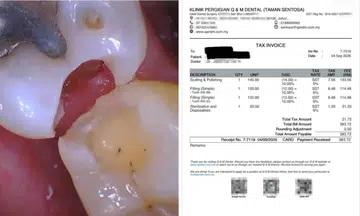 woman JB dentist cavity tooth