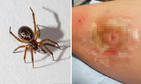 Man left with gaping hole on leg after getting bitten by Britain's most venomous spider
