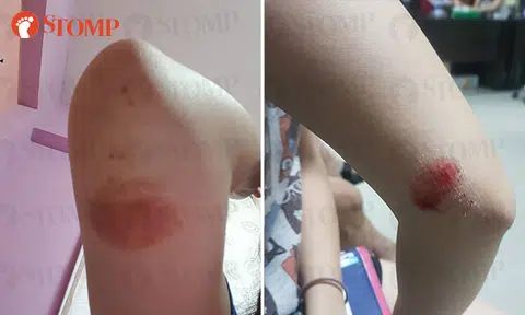 Injured e-scooter rider appealing for witnesses to accident at Admiralty MRT Station zebra crossing