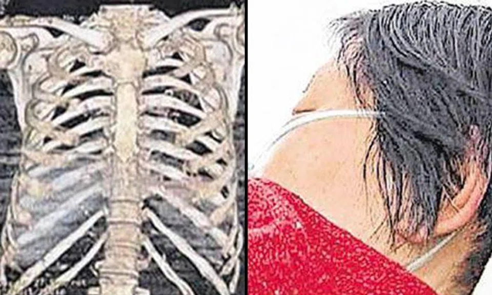 67-year-old woman suffers 11 broken ribs after getting beaten by son who wanted her house in China