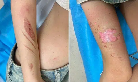 A customer suffered extensive burns on multiple parts of her body during a moxibustion treatment at foot massage shop in Jalan Besar. PHOTO: SHIN MIN DAILY NEWS