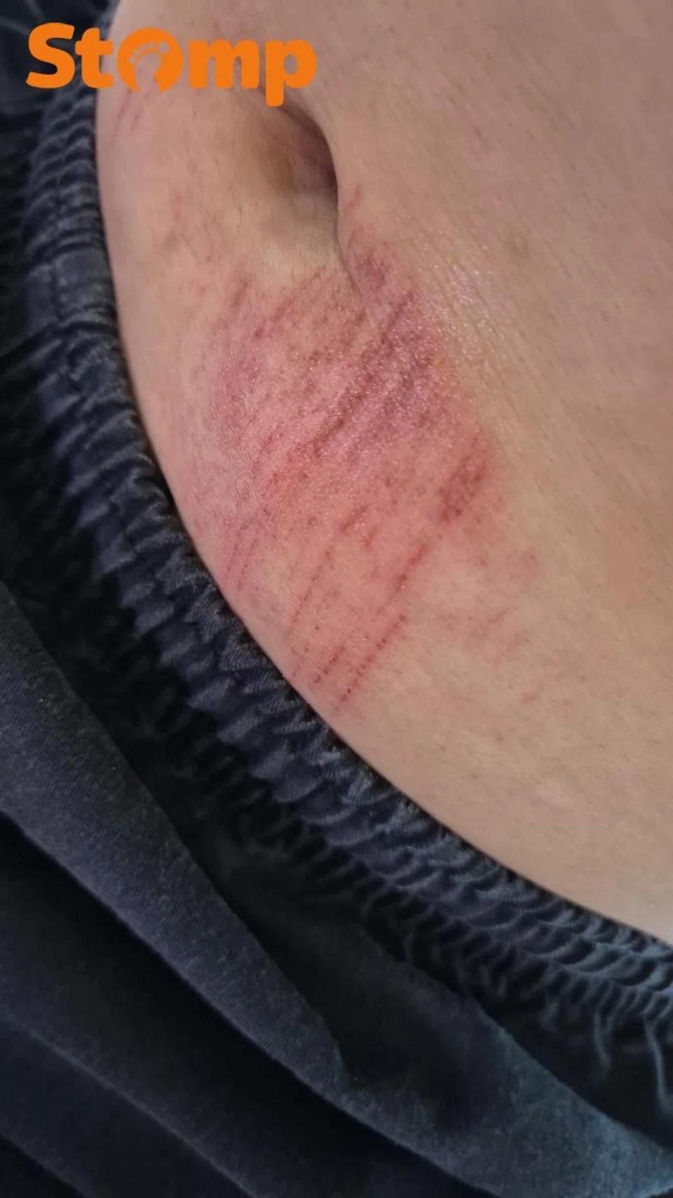 The Stomper had a wound on his abdomen.