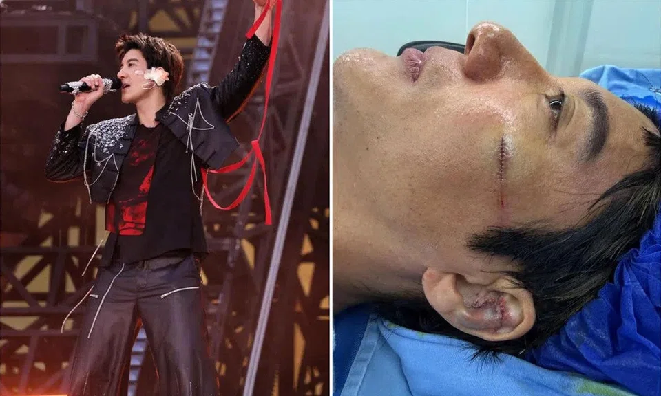 Wang Leehom needed 39 stitches to his face and ear after a fall at his concert in Chengdu on July 4.