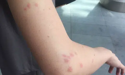 Scoot investigates passenger's bed bug claims after her critical FB post