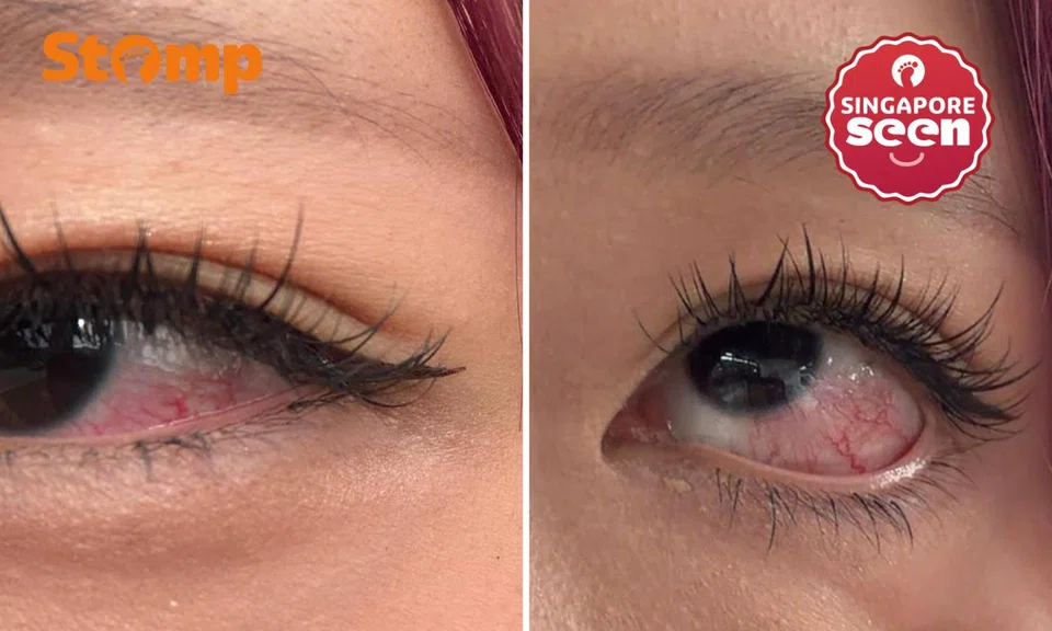 woman suffers eye pain after free lash treatment