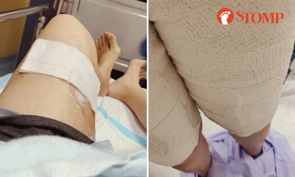 Stomper Jen was diagnosed with second-degree burns.