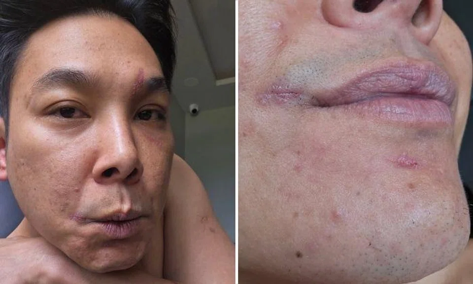 Actor Ryan Lian's face scarred after slashing outside Nex: 'Why do I suddenly feel like the Joker?'