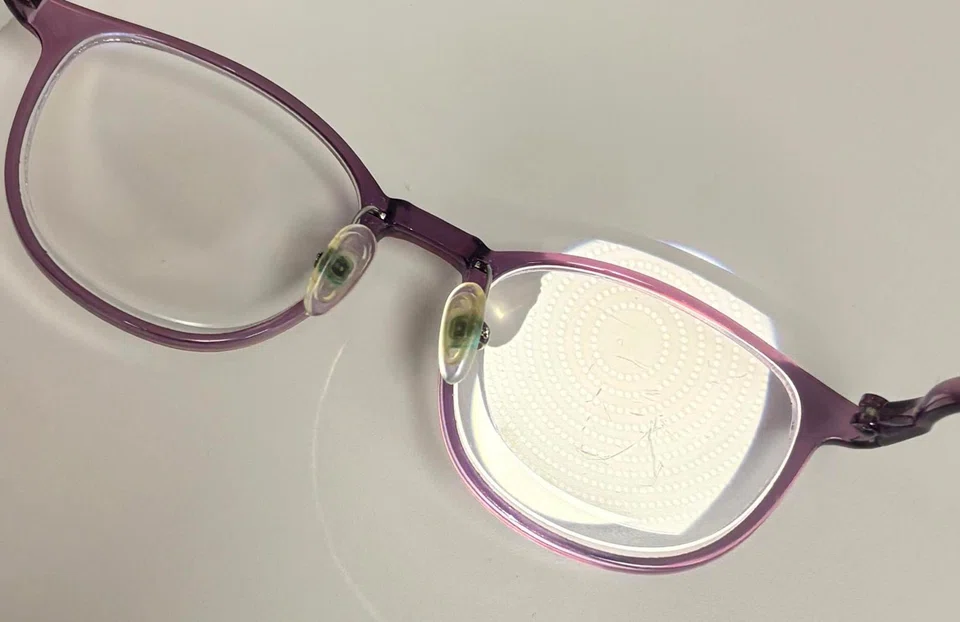 Children with high myopia face an increased risk of eye diseases such as cataracts and glaucoma in adulthood.