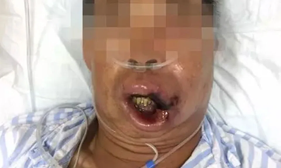 A doctor who treated the man said the area near the corner of his upper lip had turned black which signaled the tissue there had died.  Photo: Weibo