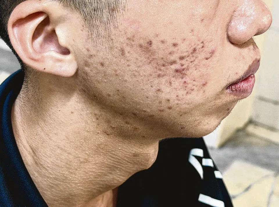 Mum says NSF son, 20, pressured to spend $3.3k to cure acne