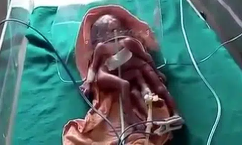 Baby with 2 torsos, 4 legs and 4 arms dies shortly after birth in India