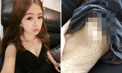 Young mum posts 'shocking' photo of sagging belly covered in stretch marks, gains support from netizens