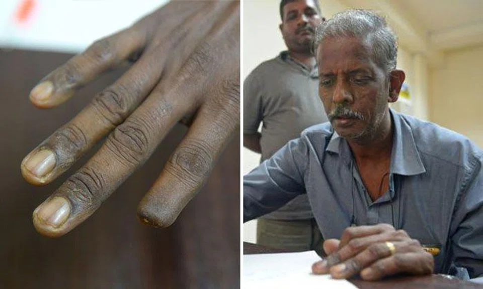 Worker whose fingers were crushed by falling metal gets just 1 day of ...