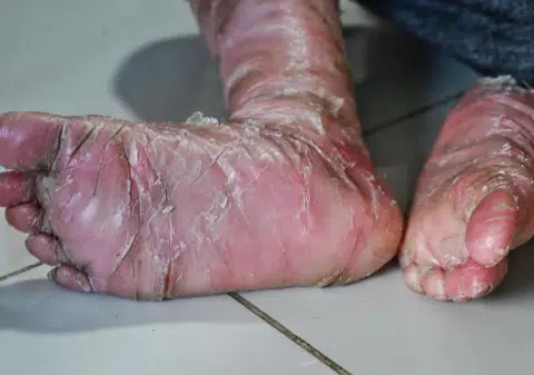 Teen with skin disease recalls being ostracised in school