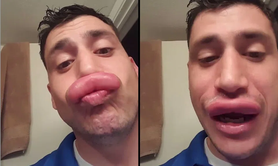 Man achieves beestung lips... literally STOMP