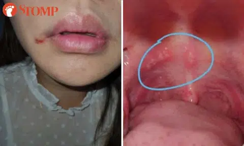 Woman scarred and in pain after 'most traumatic' root canal treatment at Sengkang dental clinic