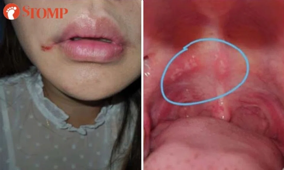 Stomper has scar on face next to her mouth and ulcerated throat after "traumatic" root canal.