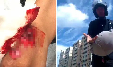 Biker suffers gruesome injuries after accident with another motorcyclist