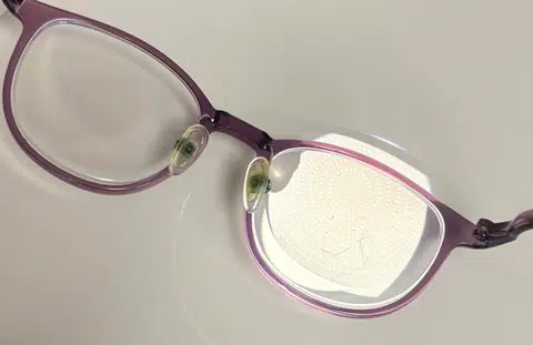 Children with high myopia face an increased risk of eye diseases such as cataracts and glaucoma in adulthood.