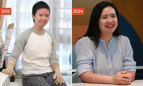 'A whole piece of burnt skin appeared to be falling off my arm': 2015 Taipei water park fire survivor
