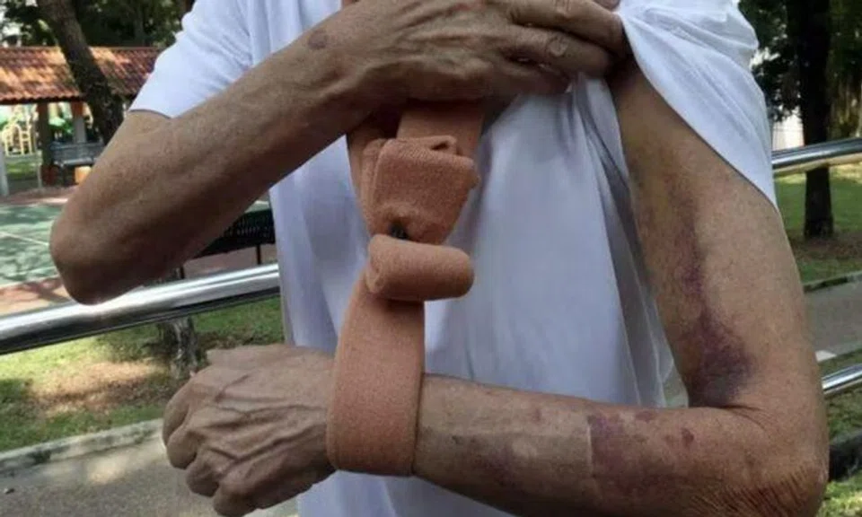 61-year-old man with diabetes fractures shoulder after tripping in park