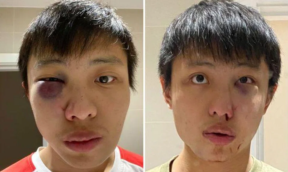 Singaporean student Jonathan Mok was jumped by a group of strangers in London in a coronavirus-related racist attack on Feb 24, 2020. Photos: Jonathan Mok/Facebook
