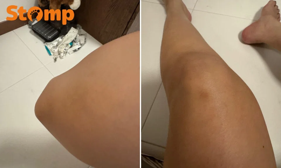 Photos show bruising on her arm and leg.