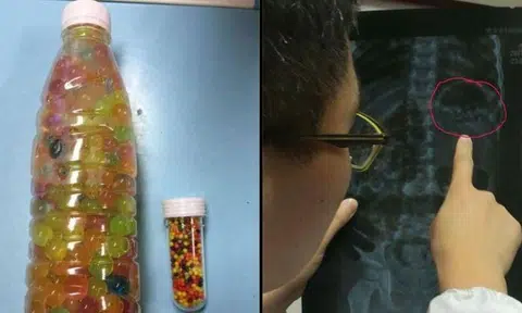 Chinese couple mistake 'water babies' for sweets -- and feed their daughter nearly 300 of them