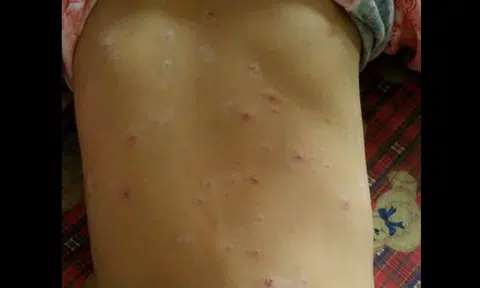 Parents complain after half of class gets chickenpox within a month at primary school in Ang Mo Kio