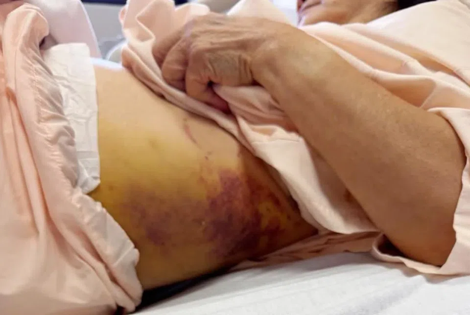 The woman suffered a spinal fracture and broken ribs.