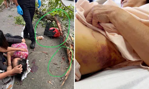 Woman still in extreme pain, has spinal fracture and cracked ribs after getting hit by tree branch