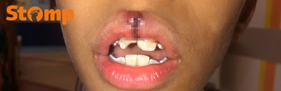 Outram Secondary School student suffers broken teeth and stitched lip after alleged assault by classmate, principal says disciplinary action under way