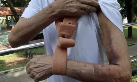 61-year-old man with diabetes fractures shoulder after tripping in park