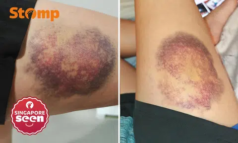 woman suffers large bruise on thigh after Go-Ahead bus suddenly stops